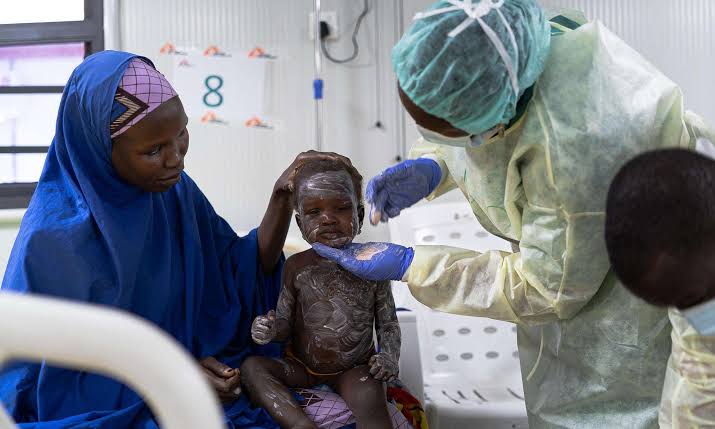 Measles outbreak claims 109 lives as infections spread across Nigeria